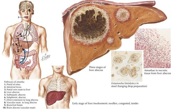 Amoebiasis 